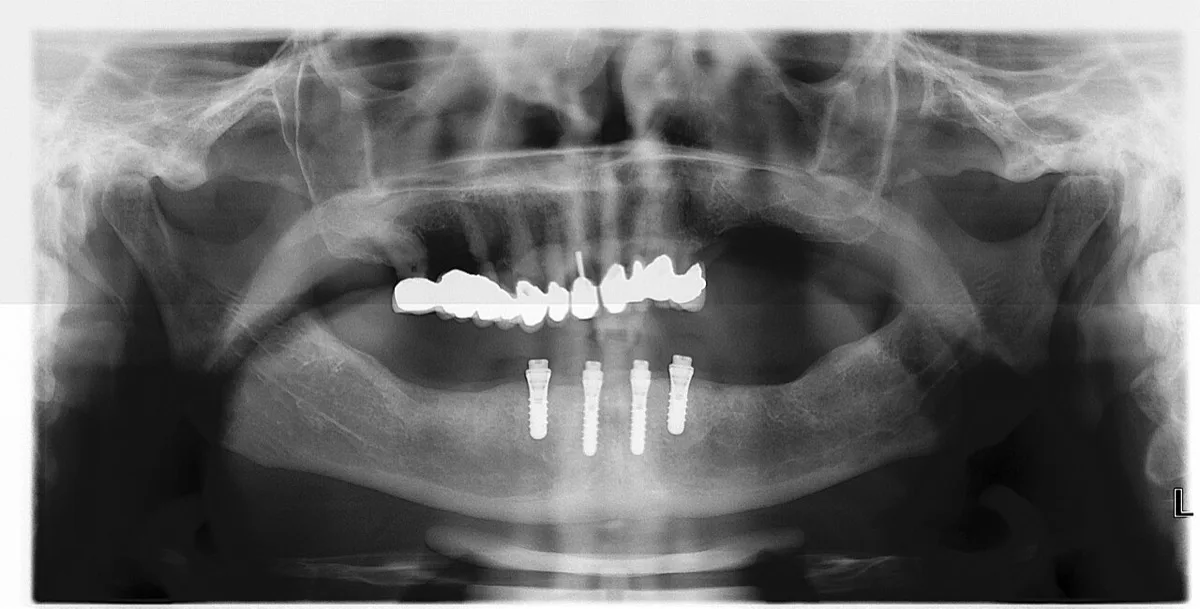 Protocolo All-on-4 — protese dentaria fixa sobre implantes em Niteroi