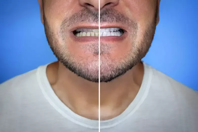 Antes e depois de clareamento dental — resultado real na Oral Unic Niteroi