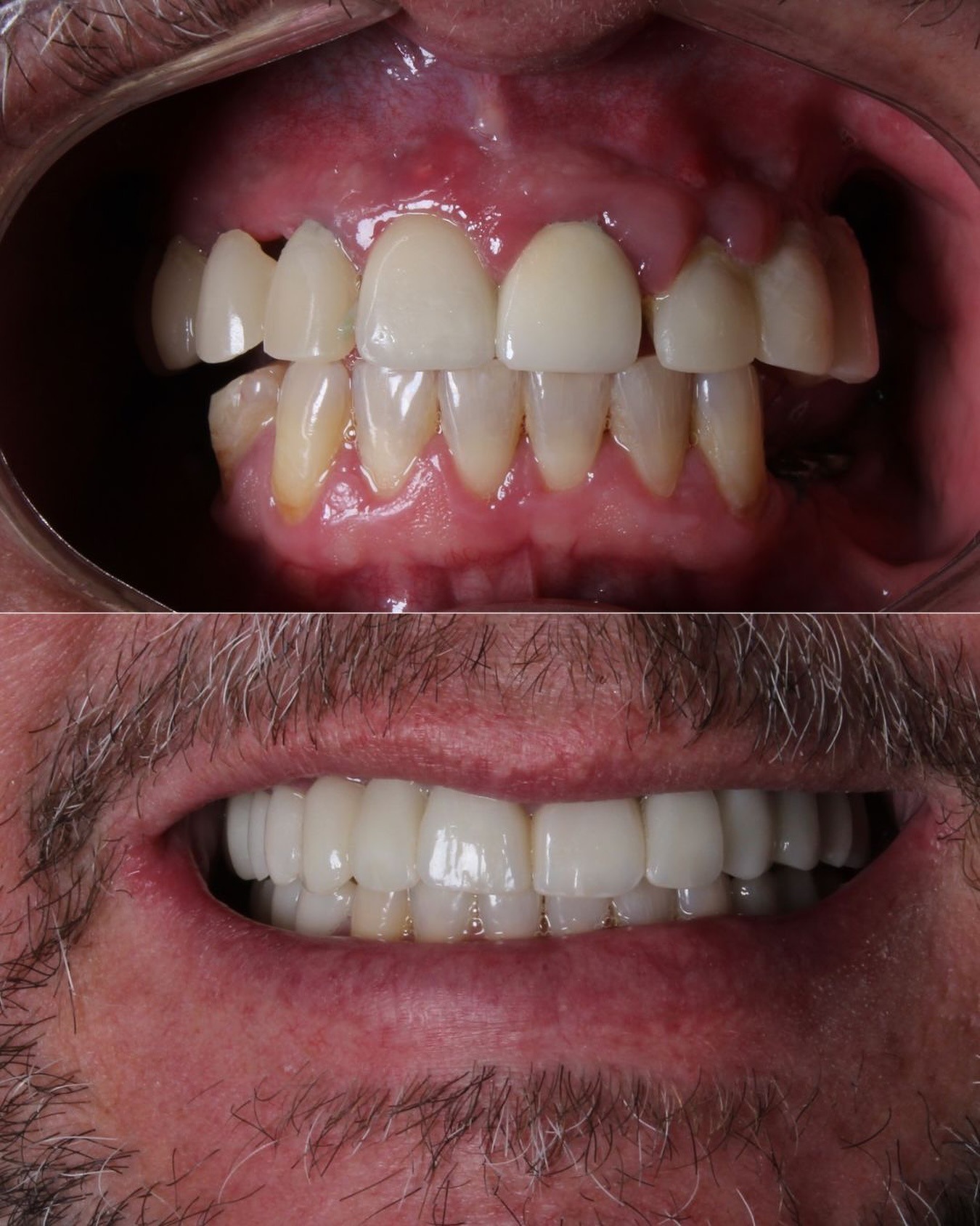 Antes das facetas de porcelana