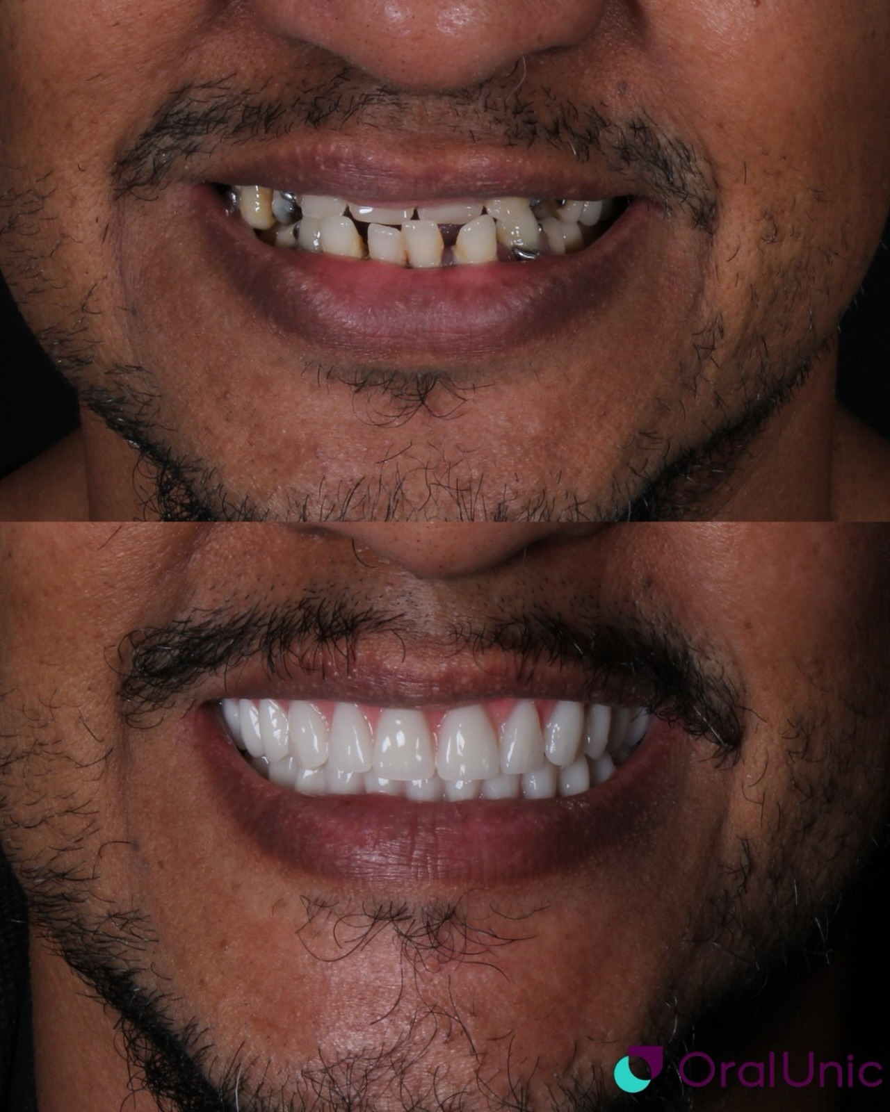 Depois das facetas de porcelana na Oral Unic, Niteroi